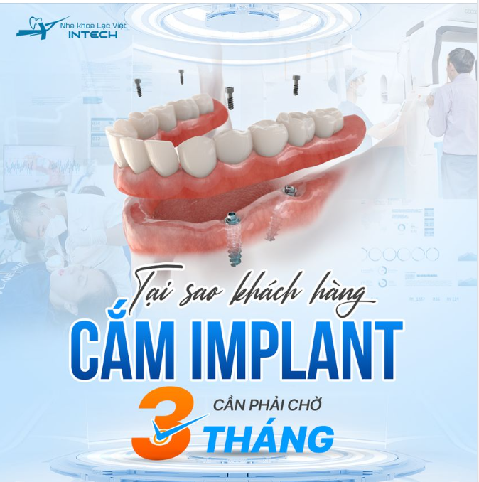 Tại sao cấy ghép implant cần chờ 3 tháng mới lắp phục hình?