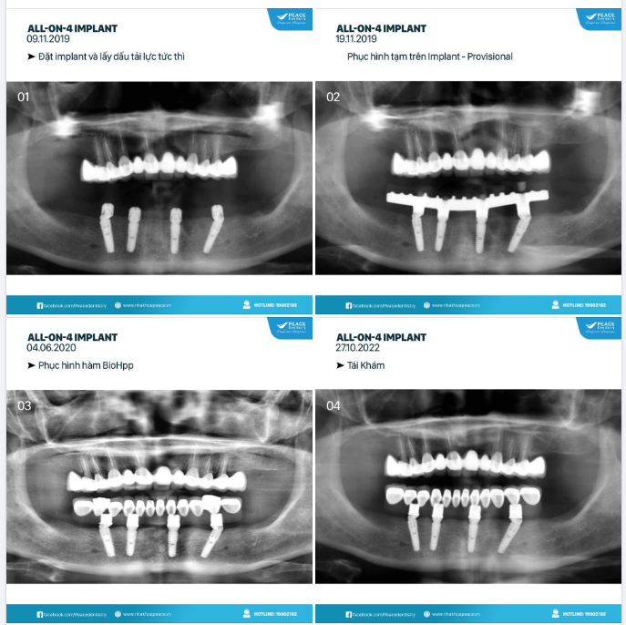 ALL-ON-4 IMPLANT LÀ SỰ THAY THẾ HOÀN HẢO CHO HÀM THÁO LẮP