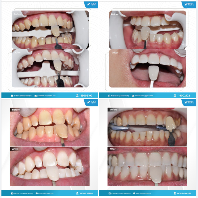 Răng trắng bật tone gần như tức thì giúp bạn tự tin và cuốn hút hơn trong từng khoảnh khắc của bữa tiệc.