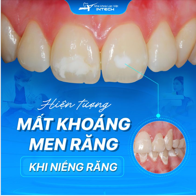 Mất khoáng men răng: 90% đồng niềng gặp phải