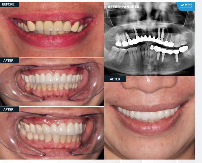 Cô khách hàng Việt Kiều đến gặp bác sĩ Peace Dentistry với hàm răng đã xuống cấp, mất răng nhiều năm và đang sử dụng các cầu răng sứ.