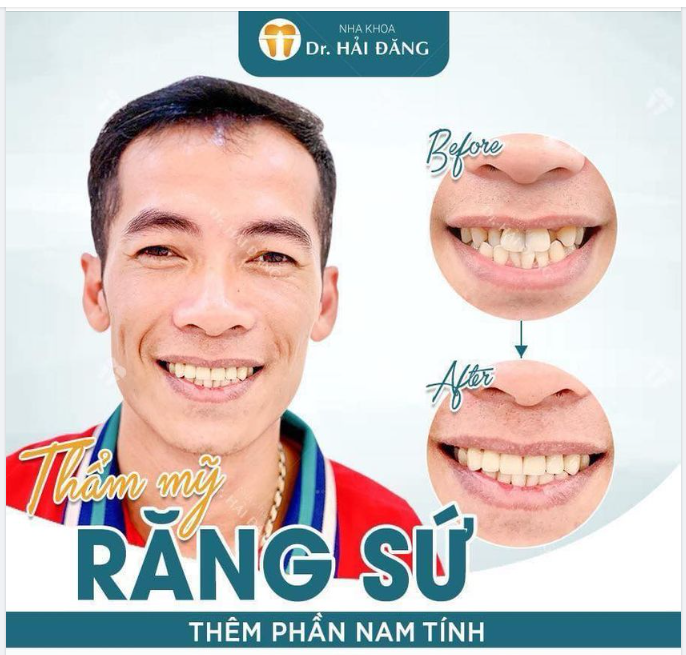 THẨM MỸ RĂNG SỨ THÊM PHẦN NAM TÍNH