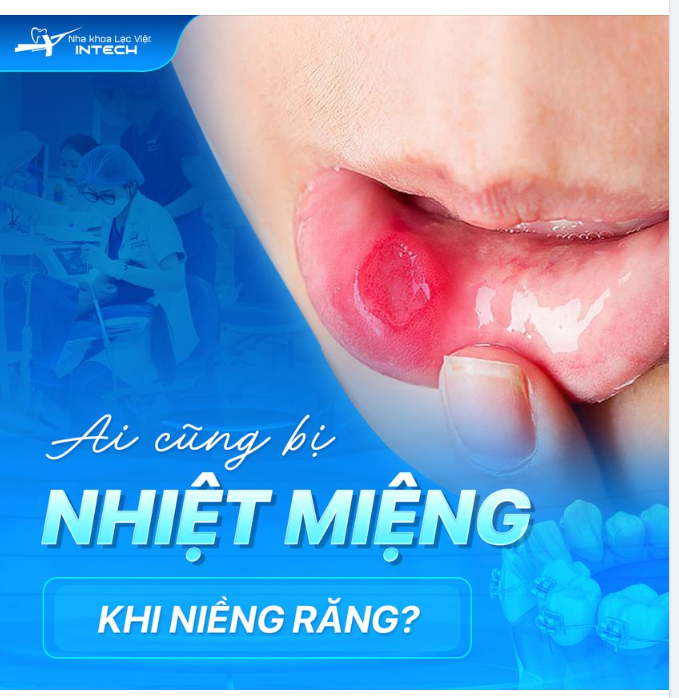 Ai cũng bị nhiệt miệng khi niềng răng