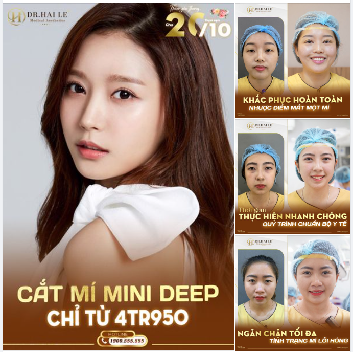 Cắt mí Mini Deep tại Dr.Hải Lê chỉ từ 4tr950. Mức giá vô cùng hợp lý!