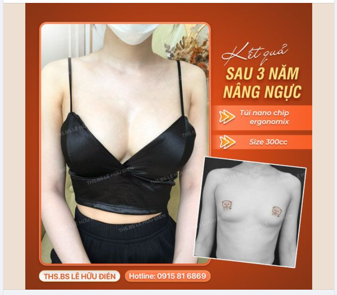 Hình ảnh Vòng 1 sau 3 năm thực hiện nâng V1 tại Bs Điền