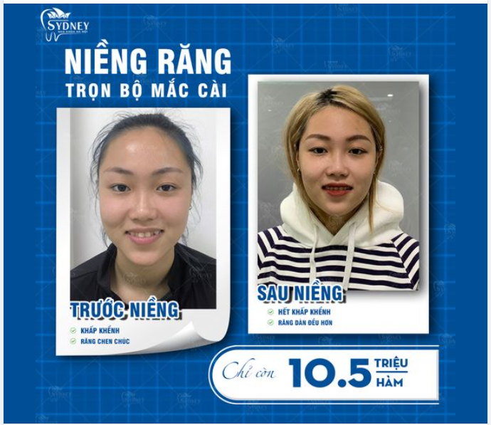 NIỀNG RĂNG GIÚP BẠN THAY ĐỔI NHƯ THẾ NÀO?
