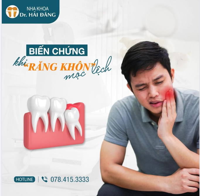 BIẾN CHỨNG KHI RĂNG KHÔN MỌC LỆCH