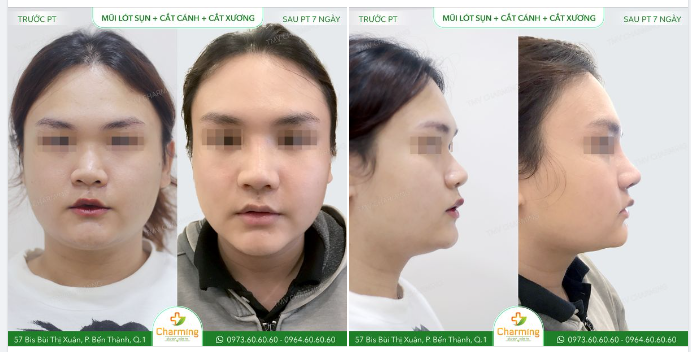 Ca mũi cũng khá nhiều vấn đề khi tổng chiều dài mũi vốn đã ngắn, lại còn thêm xương nền mũi bè, cánh mũi to.