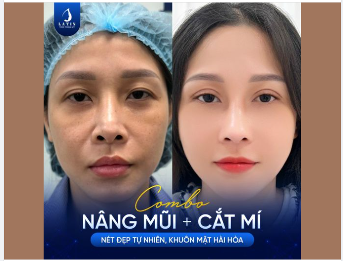 Kết quả combo Nâng mũi + Cắt mí sau 2 tháng