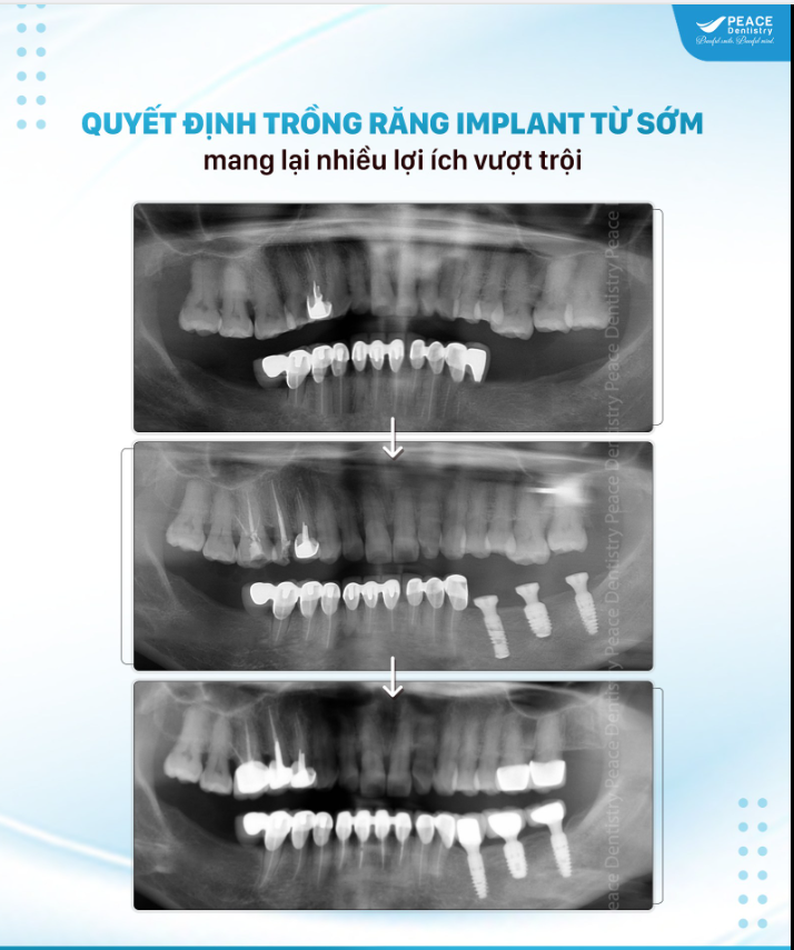 CẤY GHÉP IMPLANT NÊN THỰC HIỆN CÀNG SỚM CÀNG TỐT