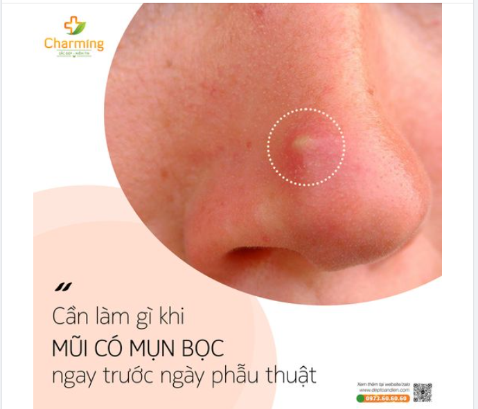 MỤN BỌC XUẤT HIỆN TRƯỚC NGÀY NÂNG MŨI THÌ NÊN LÀM GÌ ĐÂY?