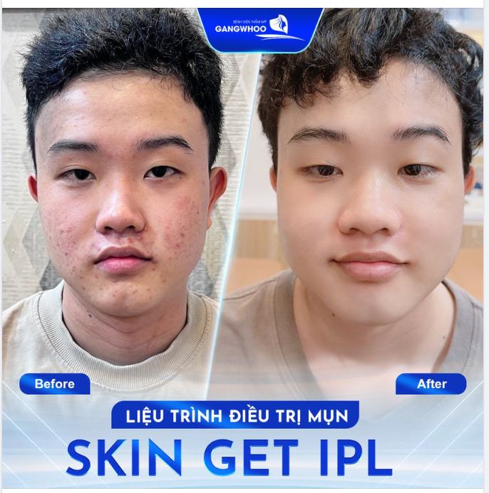 LIỆU TRÌNH ĐIỀU TRỊ MỤN SKIN GET IPL