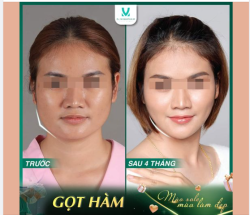 Gọt hàm Dr. Minh Phạm - kỹ thuật tạo hình khuôn mặt Vline đẹp chuẩn từng milimet