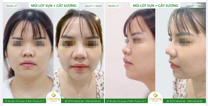 Nếu mô tả chiếc mũi cũ của bạn khách này thì chỉ có thể nói đó là một chiếc mũi bé tí, cheo leo giữa khuôn mặt.