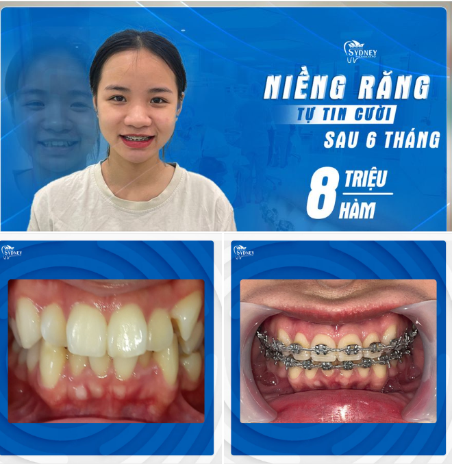 MẮC CÀI KIM LOẠI GIÚP TĂNG HIỆU QUẢ NIỀNG RĂNG NHƯ THẾ NÀO?