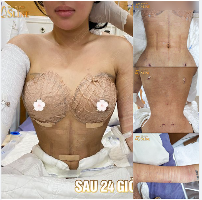SAU 24H phẫu thuật Với combo điêu khắc body: