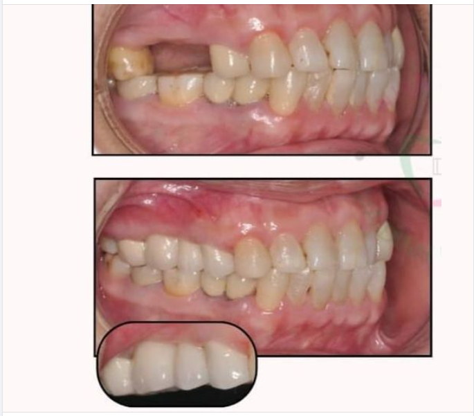 Cầu răng sứ là phương pháp phục hình răng mất bằng cách dùng răng kề bên cạnh làm điểm tựa trụ nâng đỡ.