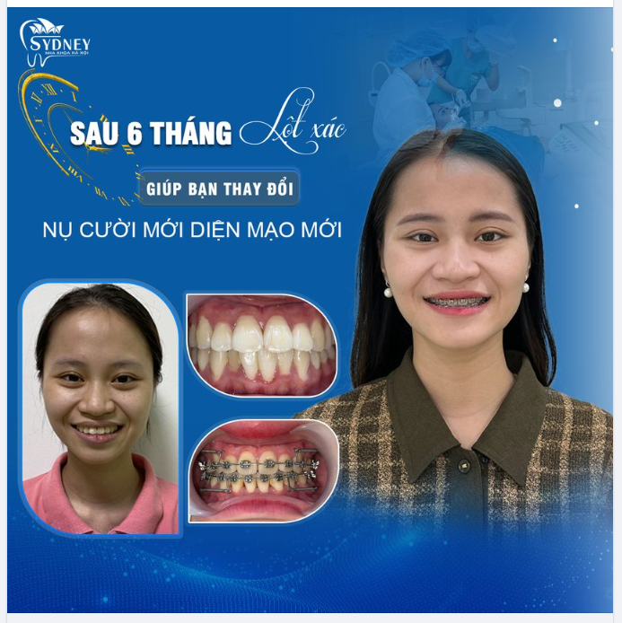 THĂNG HẠNG NHAN SẮC NHỜ NIỀNG RĂNG ĐÚNG CÁCH