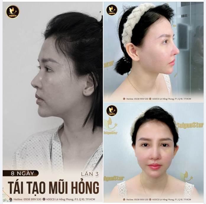 8 NGÀY NÂNG MŨI SỬA LẠI