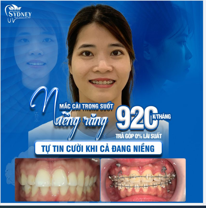 NIỀNG RĂNG TRONG SUỐT - TRẢ GÓP 0% LÃI SUẤT