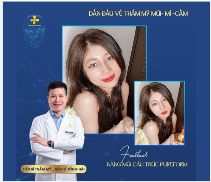 Dịch vụ bạn sử dụng là nâng mũi cấu trúc Pureform nhé cả nhà!