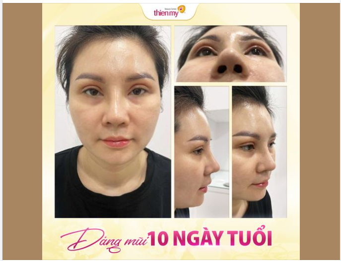 Nhan sắc gây bất ngờ của chị khách tới tái khám và cắt chỉ mũi bọc sụn