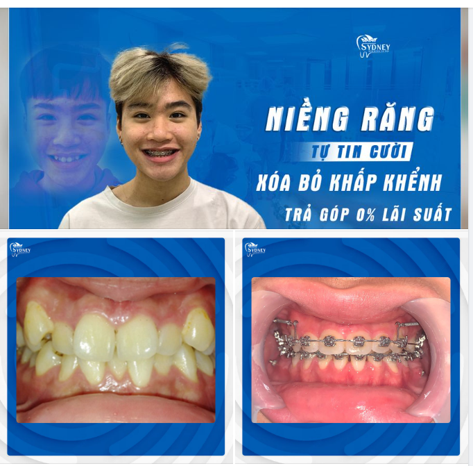 VÌ SAO NÊN NIỀNG RĂNG XÓA BỎ KHẤP KHỂNH?