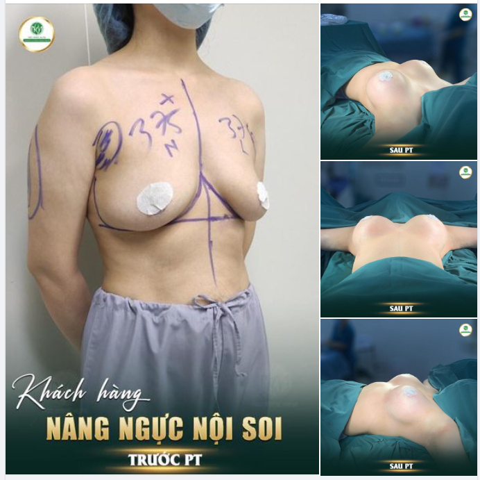 HOÀN THÀNH CA NGỰC THỨ 3 TRONG SÁNG NAY