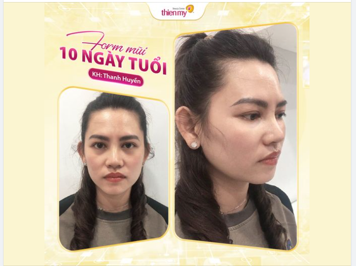 DÁNG MŨI 10 NGÀY TUỔI CỦA KH THIỆN MỸ NHƯ THẾ NÀO?