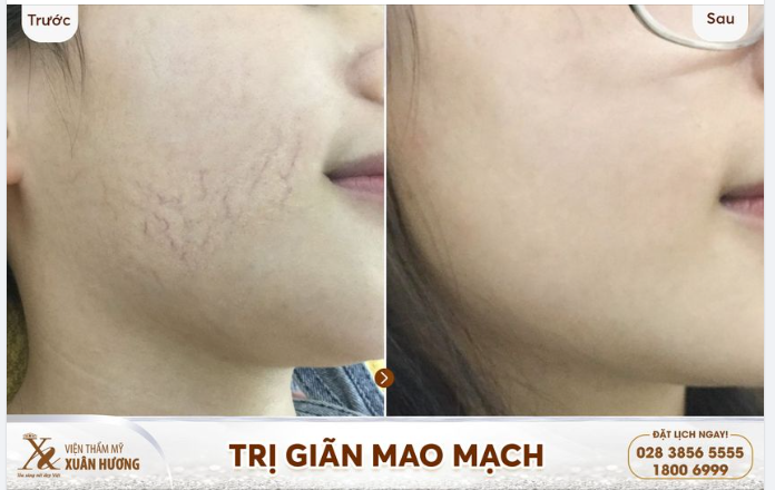 Ai cũng nói giãn mao mạch rất khó và không chữa khỏi được nhưng với công nghệ LS Pro thì mọi chuyện đều trở nên dễ dàng hơn.
