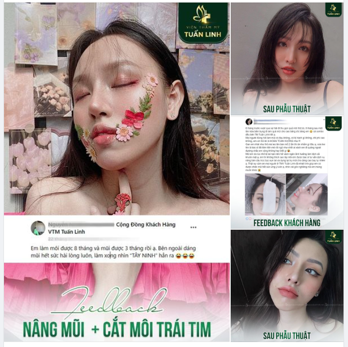 Feedback Nâng mũi + Tạo hình môi Cho gương mặt đẹp tự nhiên, trẻ trung, quyến rũ, sang chảnh.