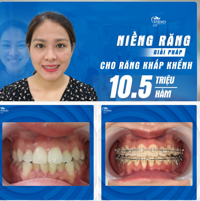 TIN ĐƯỢC KHÔNG: CHỈ 10,5 TRIỆU/HÀM ĐÃ KHẮC PHỤC ĐƯỢC RĂNG KHẤP KHỂNH