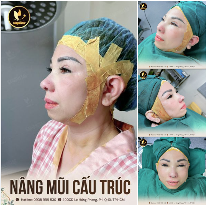 U60 VIỆT KIỀU MỸ LẦN ĐẦU NÂNG MŨI