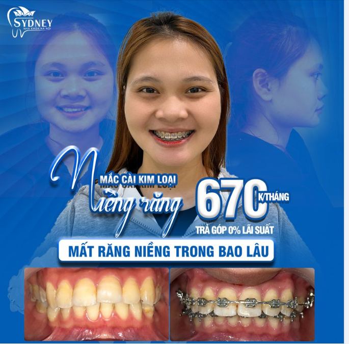 THỜI GIAN NIỀNG RĂNG MẤT BAO LÂU THÌ HIỆU QUẢ?