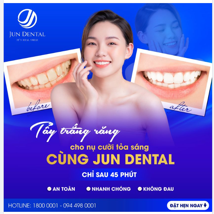 TẨY TRẮNG RĂNG CHO NỤ CƯỜI TỎA SÁNG CÙNG JUN DENTAL!