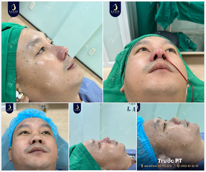 Một ca mũi nam tính, phong thủy cho anh trai đến từ Khánh Hòa