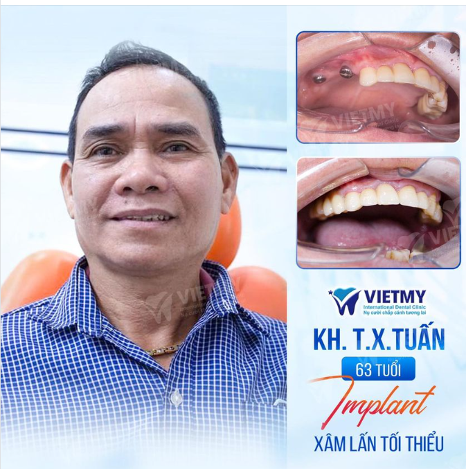 TRẺ RA 10 TUỔI NHỜ TRỒNG RĂNG IMPLANT