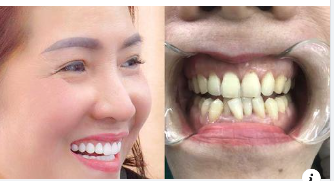 Tại sao phải bảo quản răng sứ và chăm sóc tốt nhất?