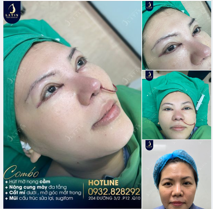 Combo dịch vụ Nâng mũi - Nâng cung mày - Cắt mí dưới + Mở góc mắt trong - Giảm mỡ vùng cằm cho chị khách hàng Việt kiều Mỹ