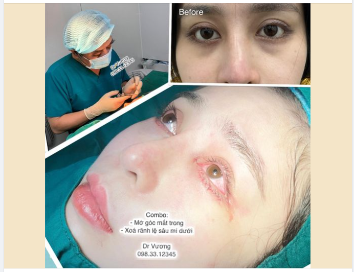 Dr Vương thực hiện phương án trẻ hoá cho bạn gái đến từ Đồng Nai bằng giải pháp đơn giàn nhưng hiệu quả: