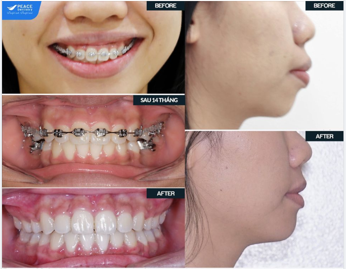 NIỀNG RĂNG CÀNG SỚM CÀNG TỐT