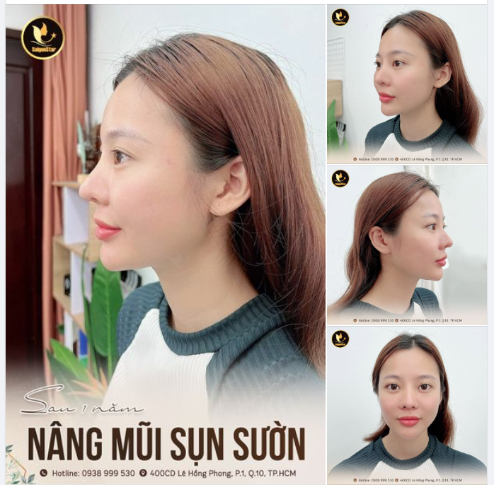 Chào tháng mới bằng bộ hình của bạn Bảo Nhi sau 1 năm nâng mũi sụn sườn. Dáng mũi vào form, đẹp hài hòa với cấu trúc ngũ quan, giúp gương mặt thanh thoát và mềm mại hơn.
