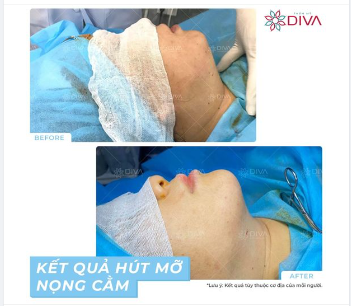 SAU GIẢM MỠ NỌNG CẰM: CẰM GỌN VLINE THANH THOÁT