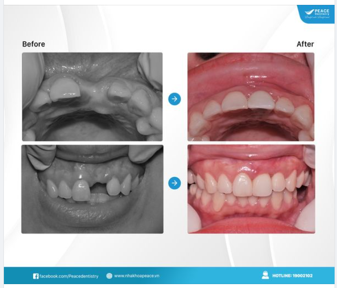 CHỌN IMPLANT ĐỂ BẢO TỒN TỐI ĐA RĂNG THẬT !