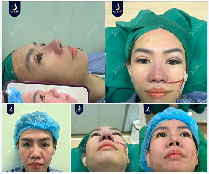 Combo mũi tái cấu trúc sụn tai kết hợp cắt mí 4D cho chị gái đến từ Bình Dương