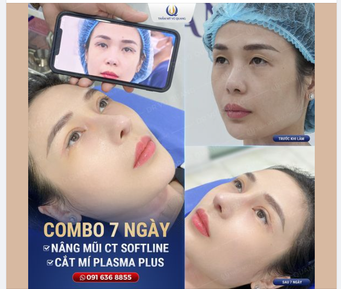 Combo Nâng mũi cấu trúc Softline + Cắt mí Plasma Plus tạo nét đẹp tự tin.