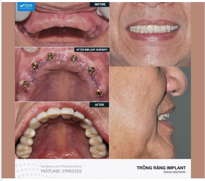 TRỒNG RĂNG IMPLANT TOÀN HÀM: LỰA CHỌN LÝ TƯỞNG THAY CHO HÀM THÁO LẮP CẦU RĂNG SỨ DÀI !