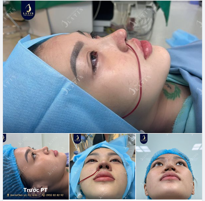 Em gái sở hữu dáng mũi gồ, và khuyết sụn cánh mũi khiến 2 lỗ mũi không đồng đều.