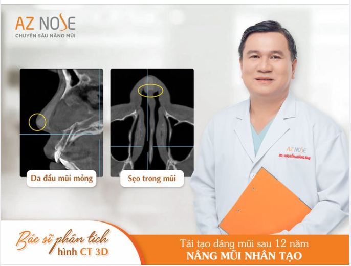 Có thể thấy gì bên trong dáng mũi đã nâng mũi nhân tạo 12 năm?