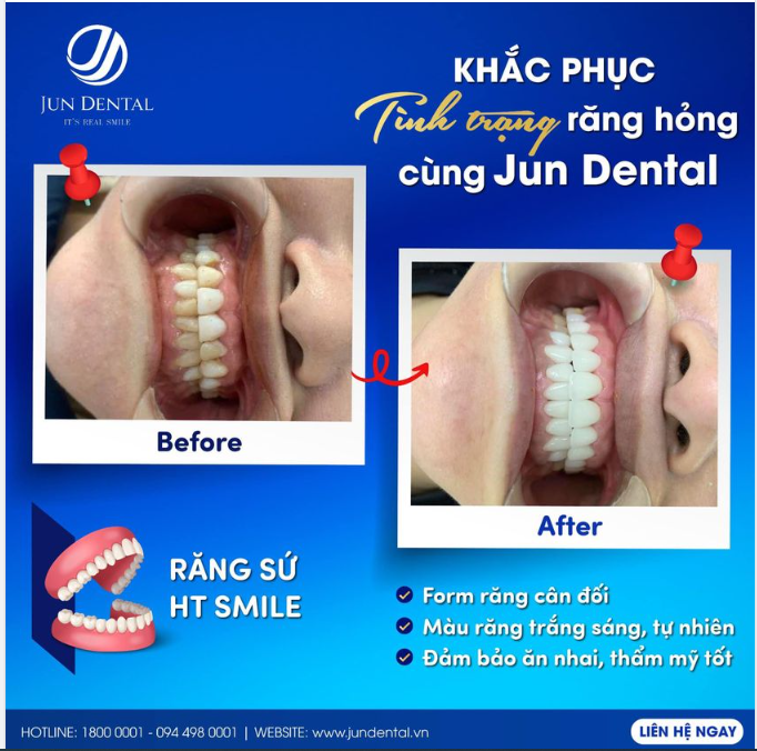 KHẮC PHỤC TÌNH TRẠNG RĂNG HỎNG CÙNG JUN DENTAL!